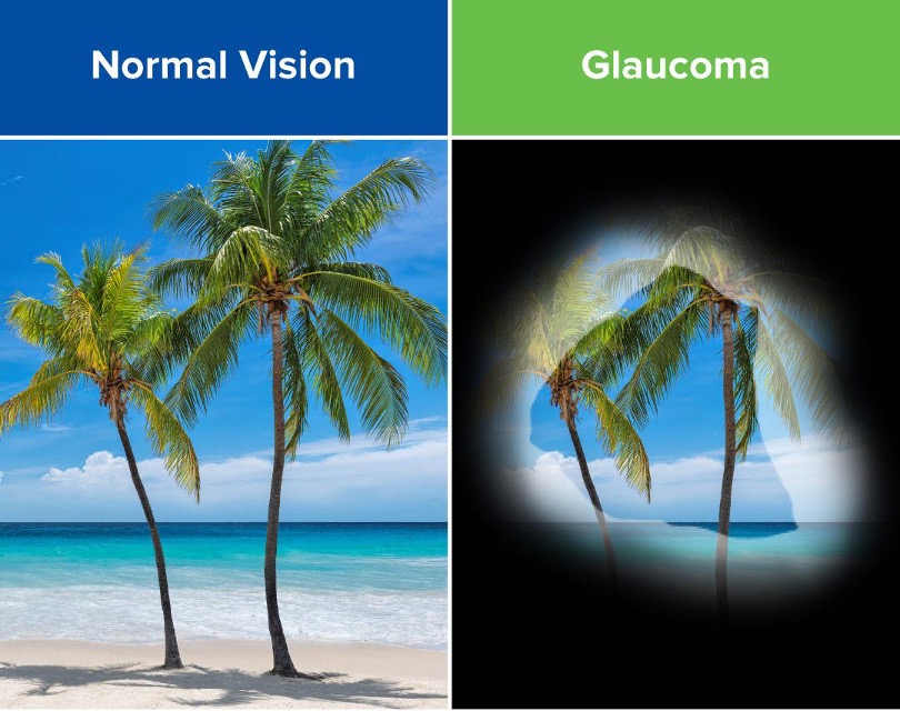 Glaucoma treatment services at Ulwe Eye Clinic Navi Mumbai